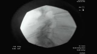 Fluoroscopic lumbar epidural injection lateral contrast spread [upl. by Mallissa95]