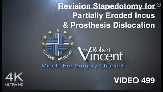 Revision Stapedotomy for Partially Eroded Incus amp Prosthesis Dislocation [upl. by Ecertak]