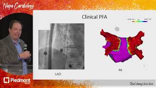 Pulsed Field Ablation ADVENT Study [upl. by Bord407]