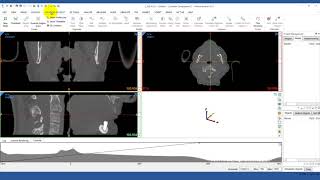 How to Import DICOM Images into Mimics  Mimics Innovation Suite [upl. by Gerardo]