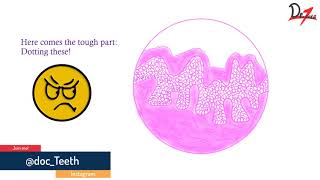 Verrucous carcinoma Histopathological features lets draw [upl. by Annairb]