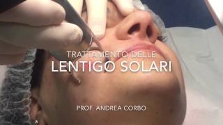 Lentigo Solari  Trattamento con Laser frazionato CO2 [upl. by Jedd]