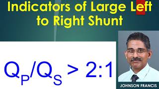 Indicators of Large Left to Right Shunt [upl. by Euv]