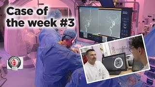 Case of the week 3  CTPerfusion and ADAPTQUATTRO for MeVO occlusions [upl. by Neira522]