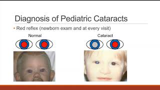 Pediatric Cataract [upl. by Eico907]