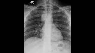 Mediastinal Lymphadenopathy cTBNA  Dr Rajdeep Dhandhukiya [upl. by Tani307]