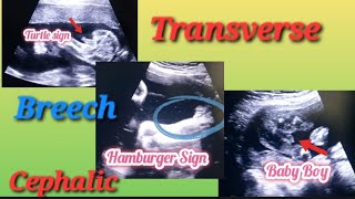 Transverse Breech amp Cephalic Baby In Uterus Genderreveal  Anterior Posterior Placenta Baby Gender [upl. by Niltiak]