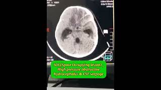 Posterior fossa SOL Brain tumor CT scan High pressure obstructive non communicating hydrocephalus [upl. by Nongim]