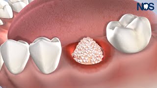 PostOp Instructions Bone Grafting at Naperville Oral Surgery amp Dental Implants [upl. by Benyamin419]