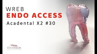 Endo Access 30 Acadental  Access Cavity Preparation for Molars [upl. by Alyak]