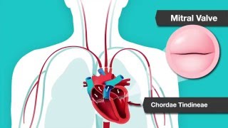 Understanding Heart Murmurs Aortic and Mitral Valve Problems [upl. by Cardew]