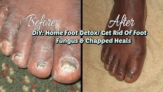 DIY Home Foot Detox How To Get Rid Of Foot Fungus [upl. by Natalina]