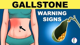 Gallbladder Stones Symptoms  Cholelithiasis  Gallstones Symptoms  Gallstones Warning Signs [upl. by Esinrahc453]