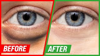 How to Get Rid of Puffy Eyes and Dark Circles [upl. by Warthman]