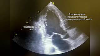 Low Ejection Fraction Низкая фракция выброса [upl. by Niel]