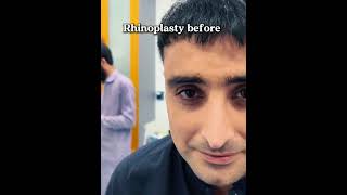 🤩heck out the shocking results of rhinoplasty by Dr Habib👃🏼👨🏽‍⚕️00923118800339 [upl. by Anived151]