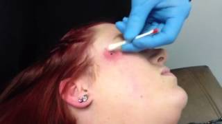 Dermal Piercing on cheek [upl. by Dionisio770]