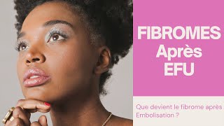 Fibromes Utérins après embolisation [upl. by Enimrej890]