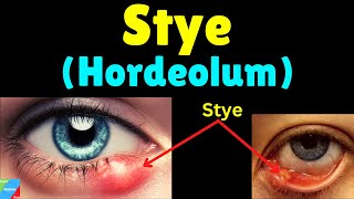 Stye Hordeolum Symptoms Causes Treatment amp Prevention – Sty [upl. by Enomas]