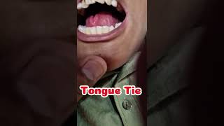 Tongue tie amp Ankyloglossia  Patients findings and clinical diagnosis [upl. by Yuh371]