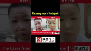 Real recovery case of ichthyosis of head and face parts ichthyosis skincare dermatologistdryskin [upl. by Lednahs]