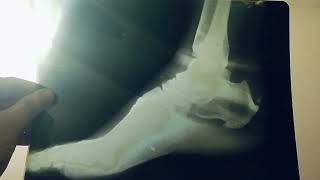 calcaneal spur orthopedics bones medicine surgery [upl. by Gide]