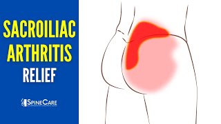 How to Instantly Relieve Arthritic Sacroiliac Joint Pain [upl. by Odom]