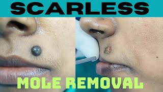 Scarless laser mole removal mole removal surgery Mole removal in Ranchi [upl. by Heiney821]