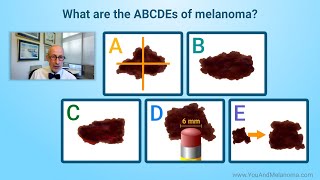 What are the signs and symptoms of melanoma [upl. by Thurston848]