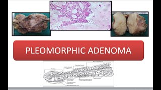 Pleomorphic Adenoma [upl. by Pepe]