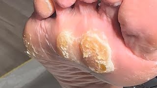 Once treated for the very thick calluses and several corns【Athlete’s foot pedicure】 [upl. by Chabot]