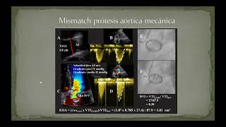 Prótesis valvulares segunda parte [upl. by Anerbes]