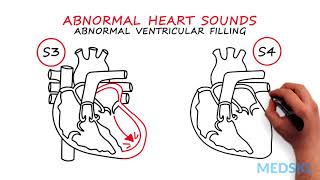 Abnormal Heartsounds and Murmurs Which heart sounds should worry you [upl. by Ydnew942]