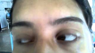 Abnormal eye movements [upl. by Leroi]