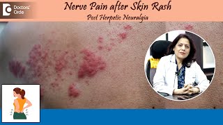 NERVE PAIN AFTER SKIN RASH Post Herpetic Neuralgia  Herpes ZosterDrSwati Bhat  Doctors Circle [upl. by Sorips]