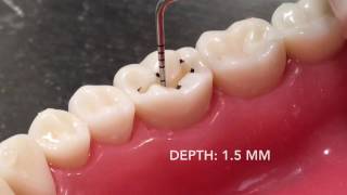 Class I Amalgam Cavity Preparation amp Restoration [upl. by Campney]