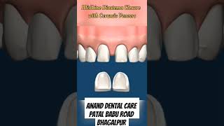 Midline diastema closure  space closing between two teeth दो दांतो के बीच जगह बन जाने पे ठीक करवाए [upl. by Sophia]