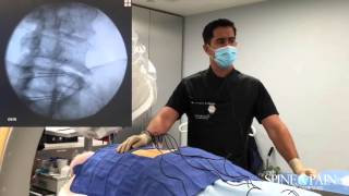 Radiofrequency Ablation Procedure [upl. by Yrolg946]