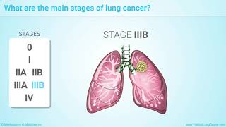 Staging of Lung Cancer [upl. by Nylsirhc813]