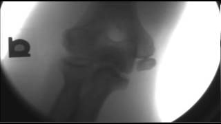 ELBOW MEDICAL EPICONDYLE AVULSION FRACTURE [upl. by Mungo]