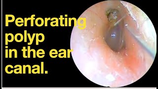 Perforating polyp in the ear canalear wax removal  ear cleaning  ASMR  relaxation  relax [upl. by Magna]