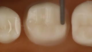 PFM Crown Posterior Tooth Preparation With Metal Occlusal [upl. by Frierson]