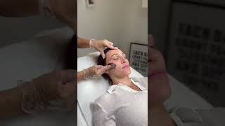 Using a spoon to massage the face after PRF PlateletRich Fibrin fillers  Clinicbe massage skin [upl. by Umeko]