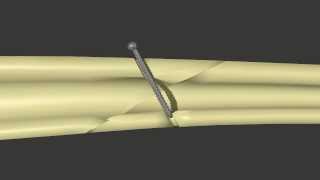 Fracture Fixation Lag Screw [upl. by Bascomb292]