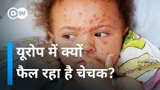 यूरोप में बढ़े चेचक के मामले Measles Outbreak in Europe [upl. by Parcel459]