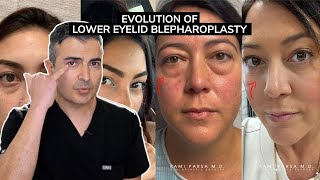 Evolution of Lower Eyelid Blepharoplasty  Dr Parsa Explains Trifecta Lift [upl. by Halle388]