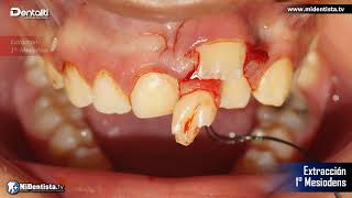 MESIODENS ¬ Dientes Supernumerarios  Cirugía  Dr Omar Noriega Gtz  wwwmidentistatv [upl. by Hamehseer]