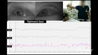 Upbeat and horizontal gazeevoked nystagmus in bilateral medial medullary infarction [upl. by Eldoria]