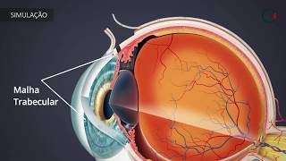 Tratamentos para o Glaucoma TRABECULECTOMIA [upl. by Ennahgiel]