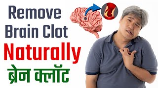 Remove Brain Clot Naturally  ब्रेन क्लॉट  Brain Stroke Treatment [upl. by Charissa]